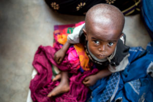 malnutrition sévère aiguë dans le Grand Kasaï